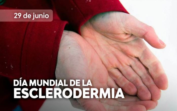 esclerodermia-en-el-hospital-senior-del-milagro